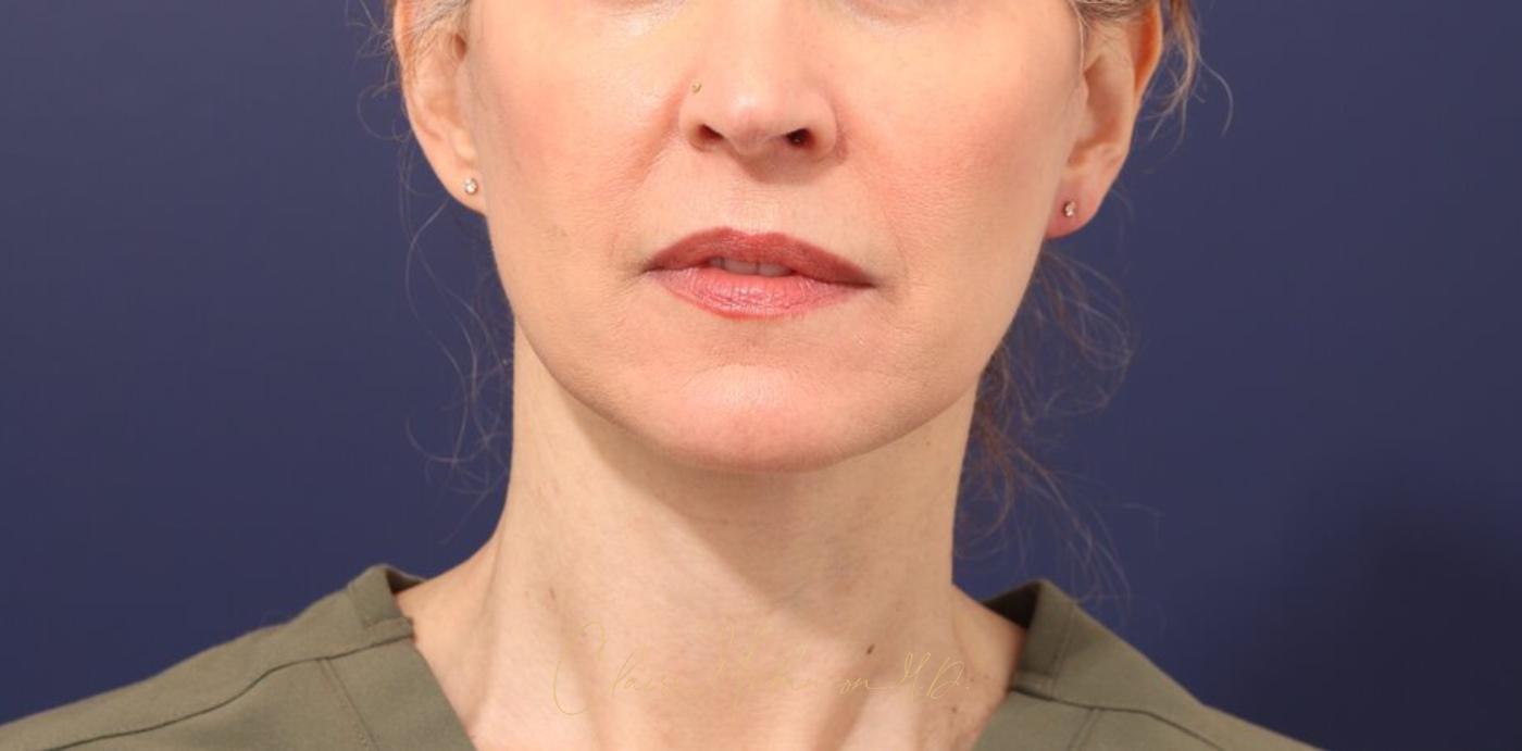 Facelift Before & After Photo