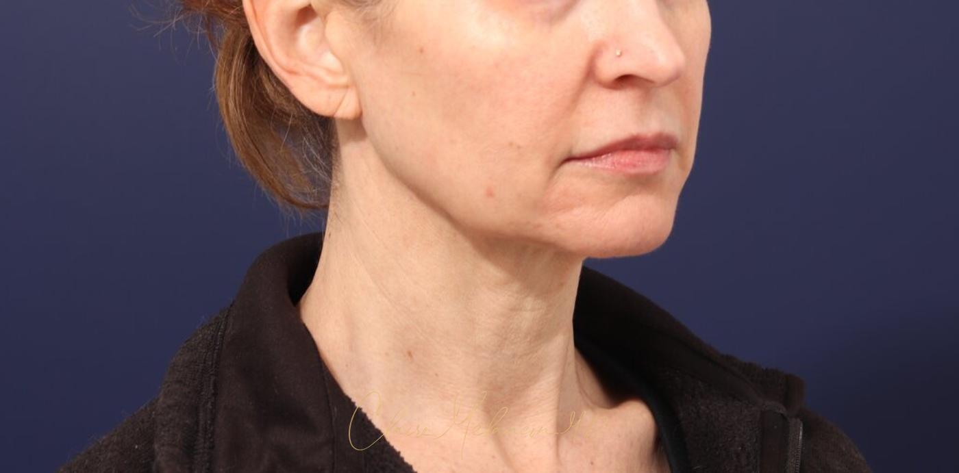 Facelift Before & After Photo