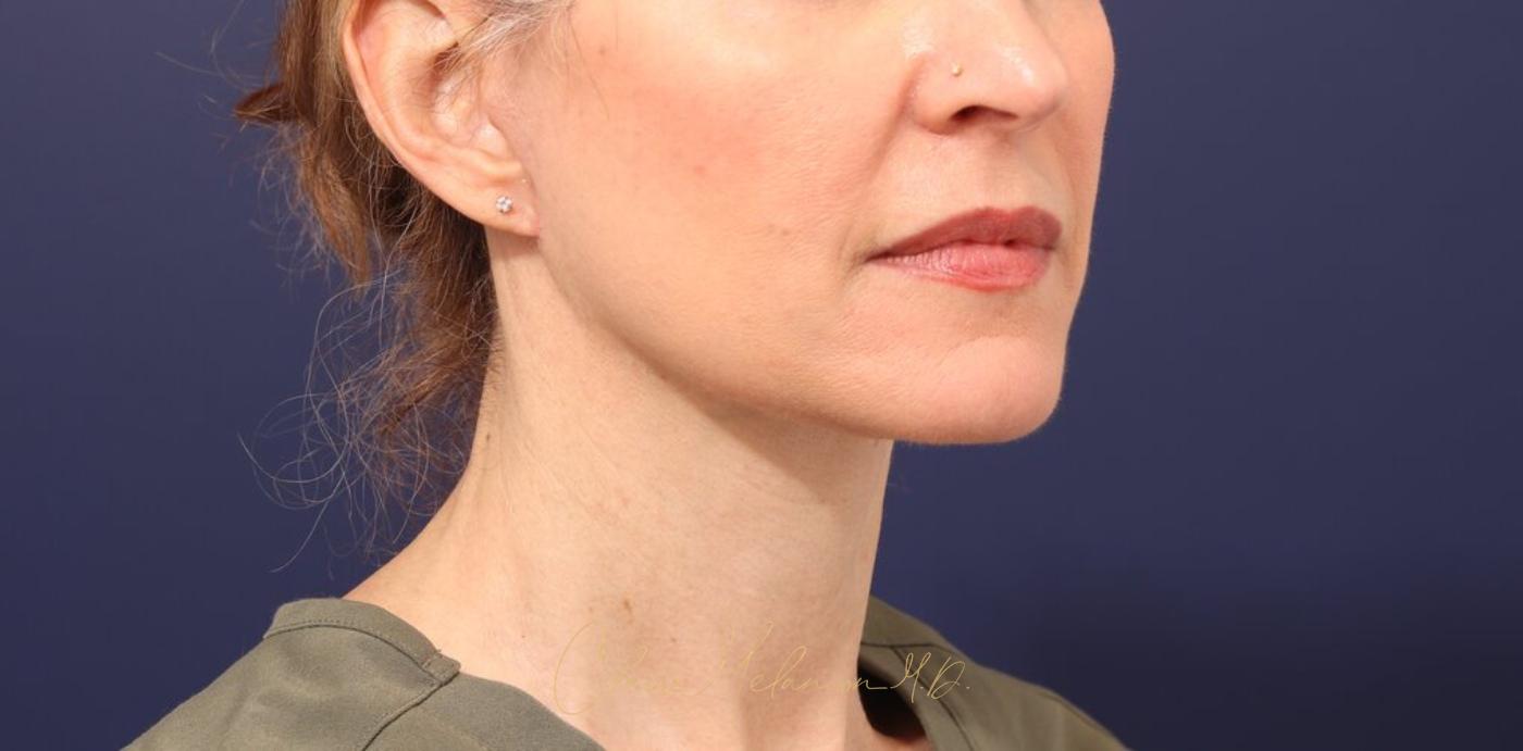 Facelift Before & After Photo