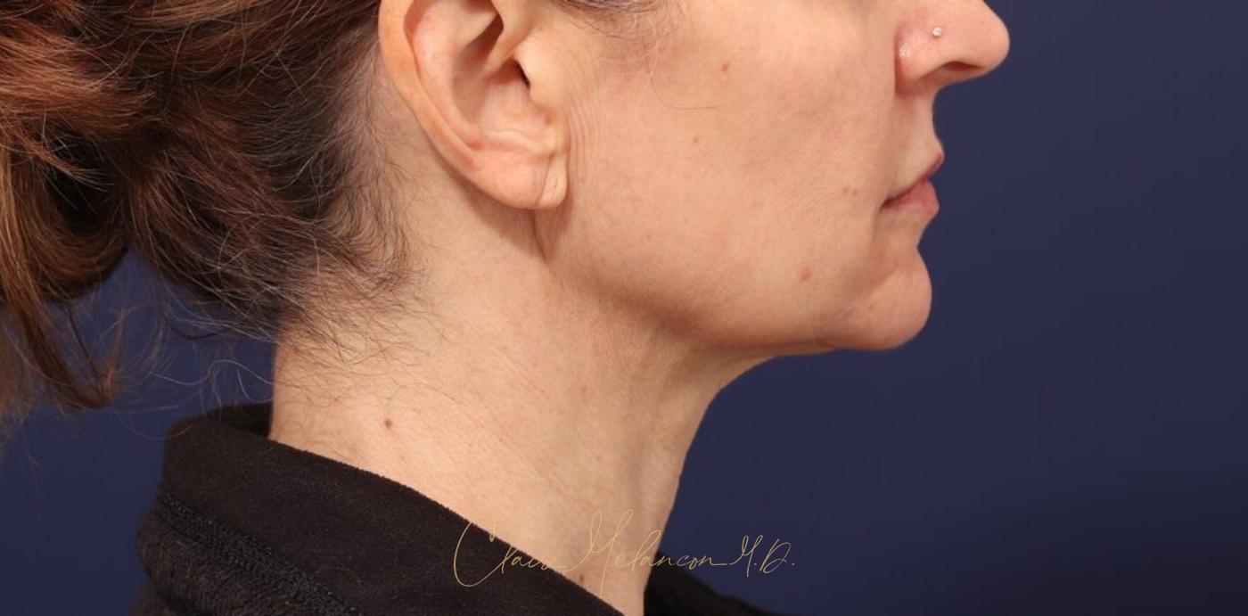 Facelift Before & After Photo