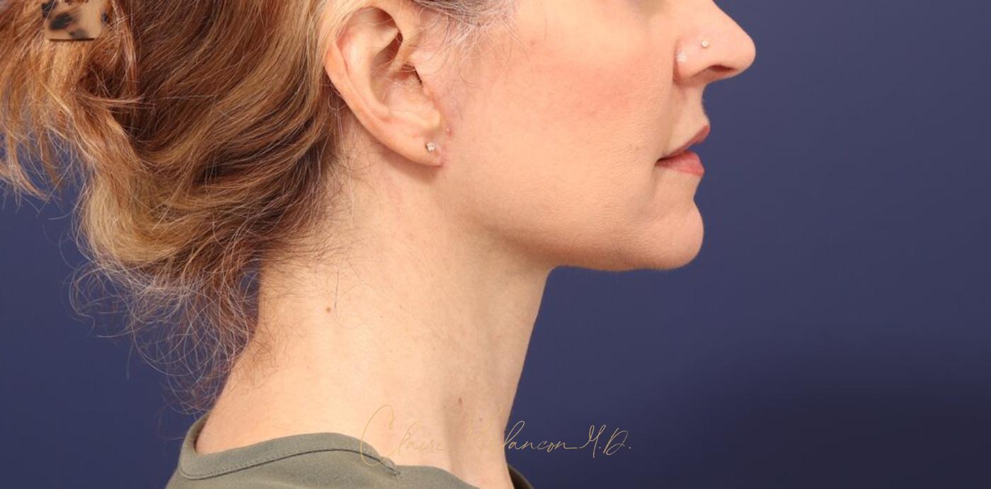Facelift Before & After Photo