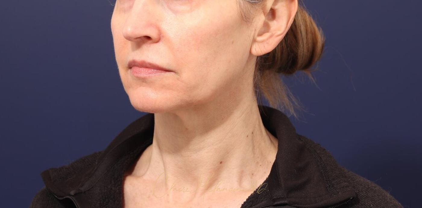 Facelift Before & After Photo