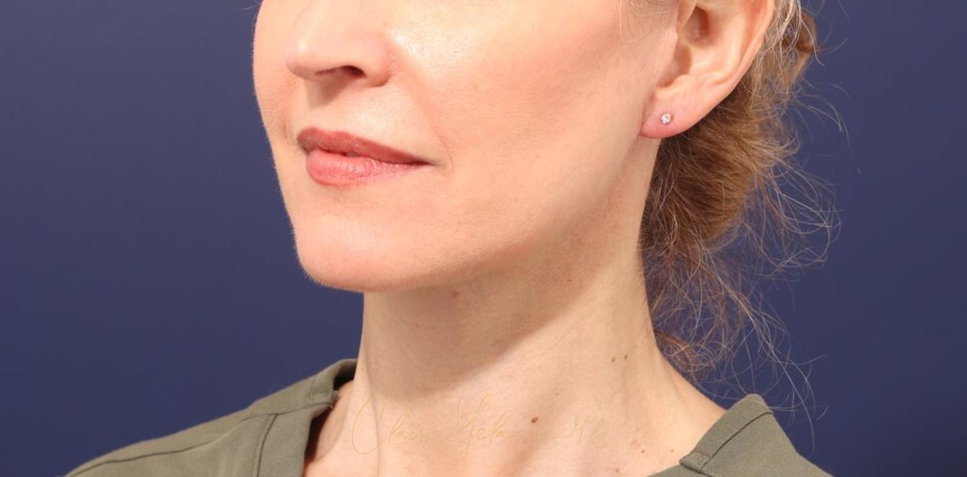 Facelift Before & After Photo