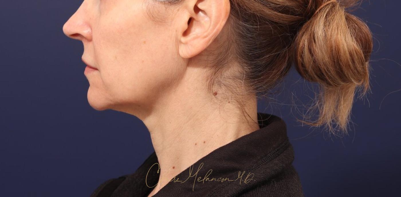 Facelift Before & After Photo