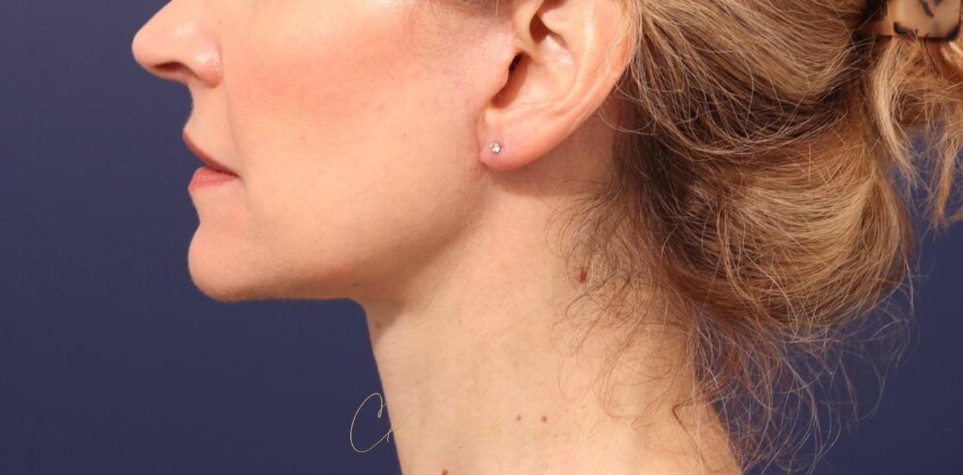 Facelift Before & After Photo