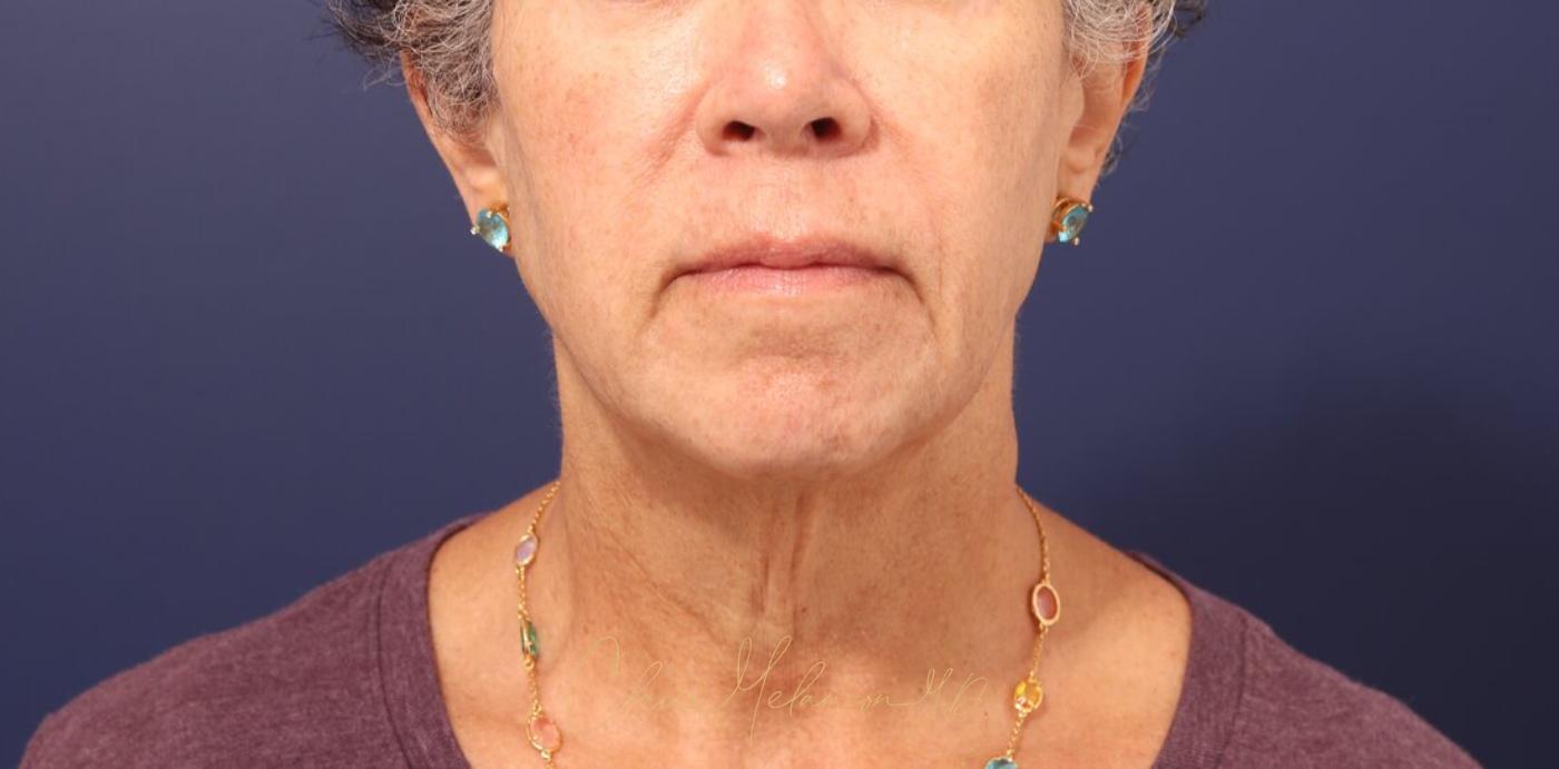Facelift Before & After Photo