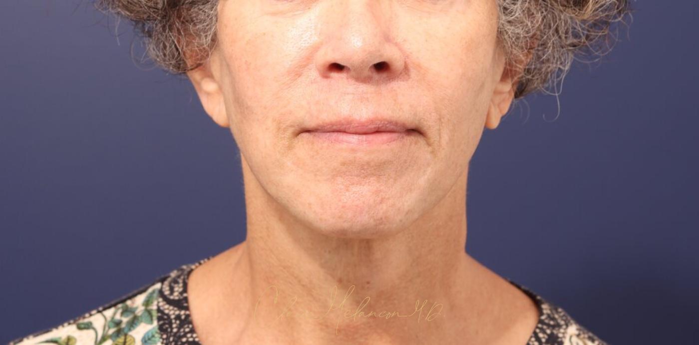 Facelift Before & After Photo