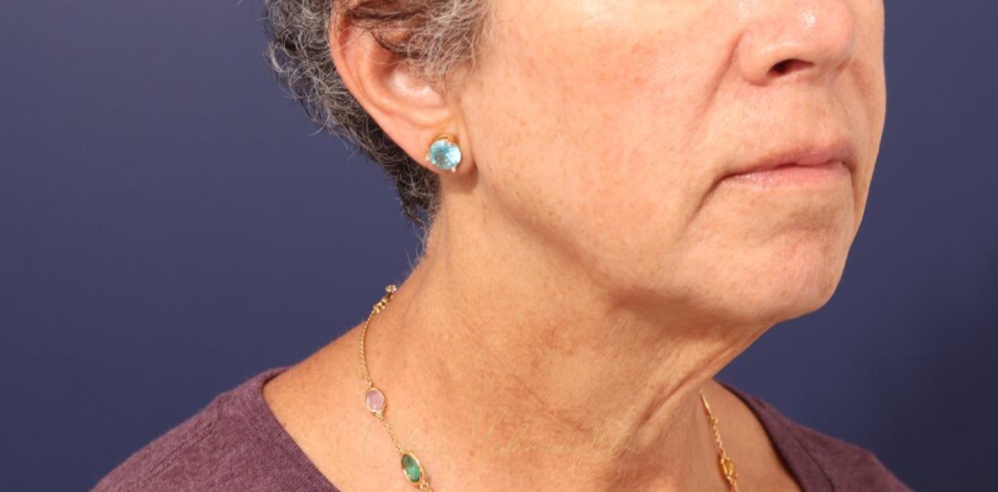 Facelift Before & After Photo