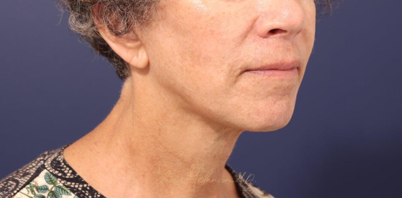 Facelift Before & After Photo
