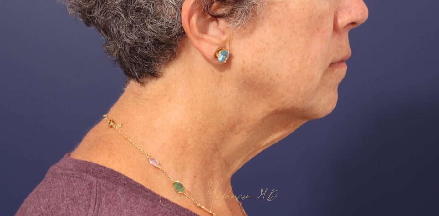 Facelift Before & After Photo