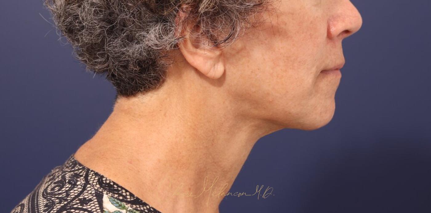 Facelift Before & After Photo