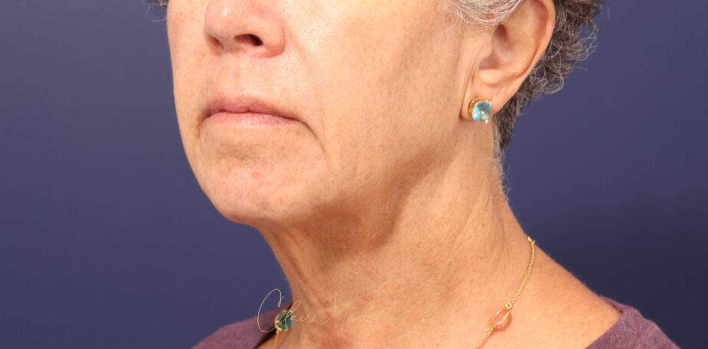 Facelift Before & After Photo