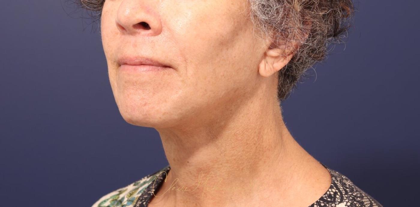 Facelift Before & After Photo