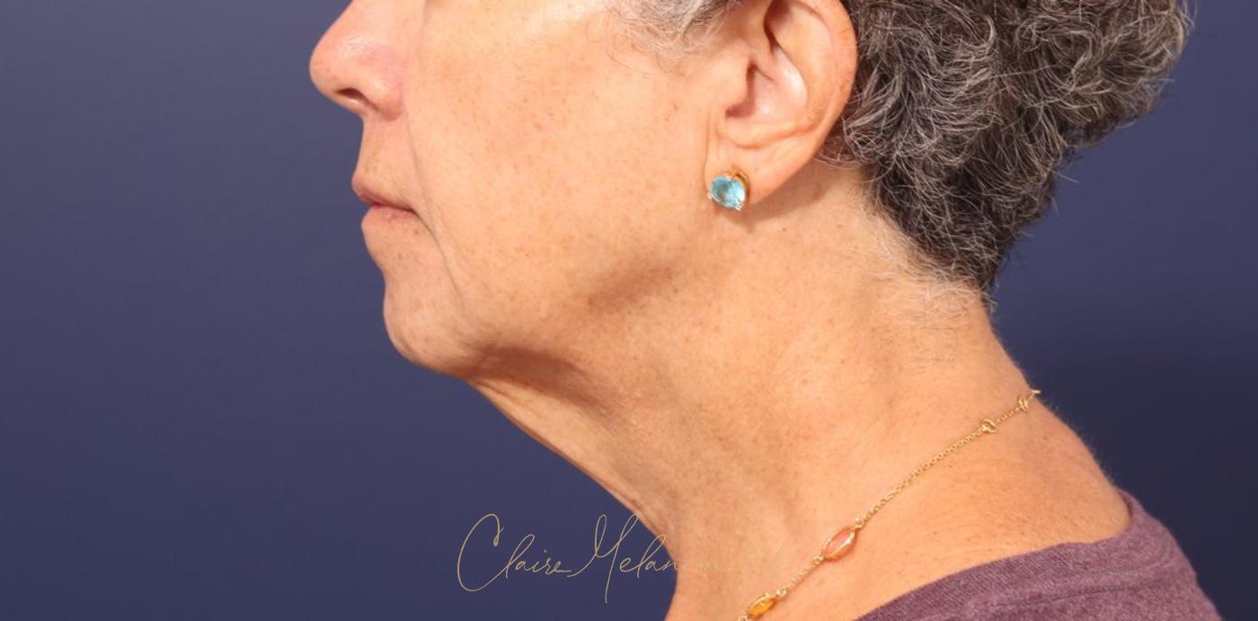 Facelift Before & After Photo