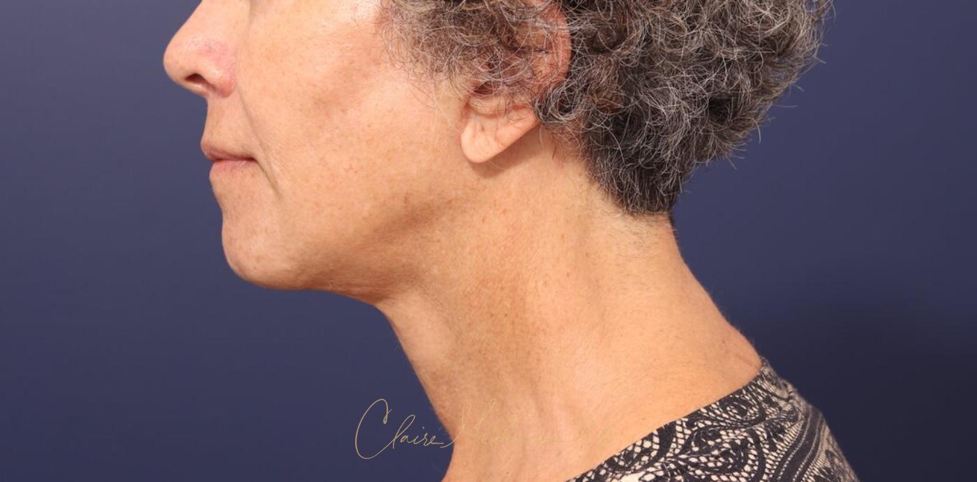 Facelift Before & After Photo