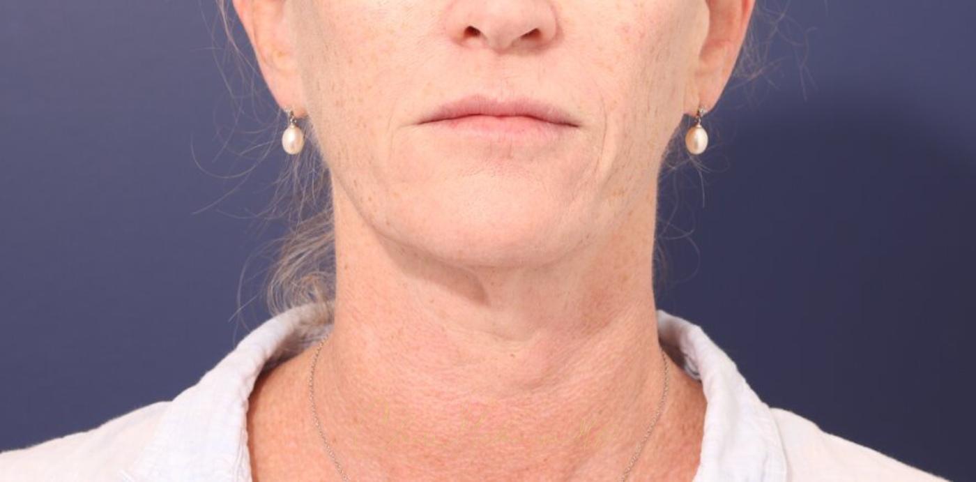 Facelift Before & After Photo