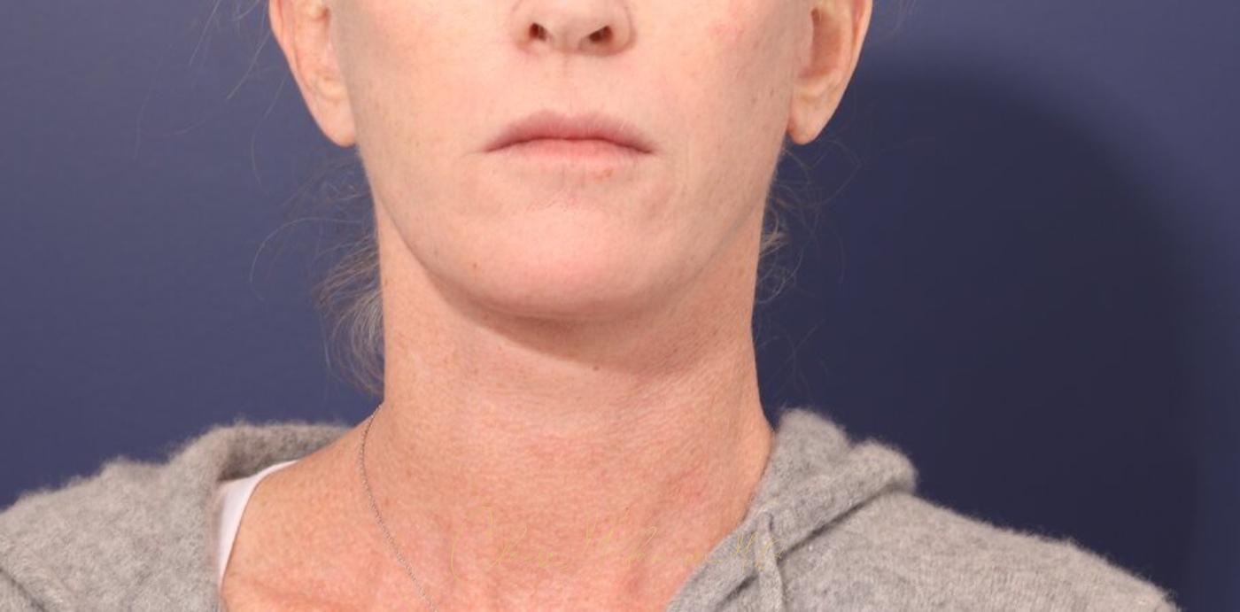 Facelift Before & After Photo