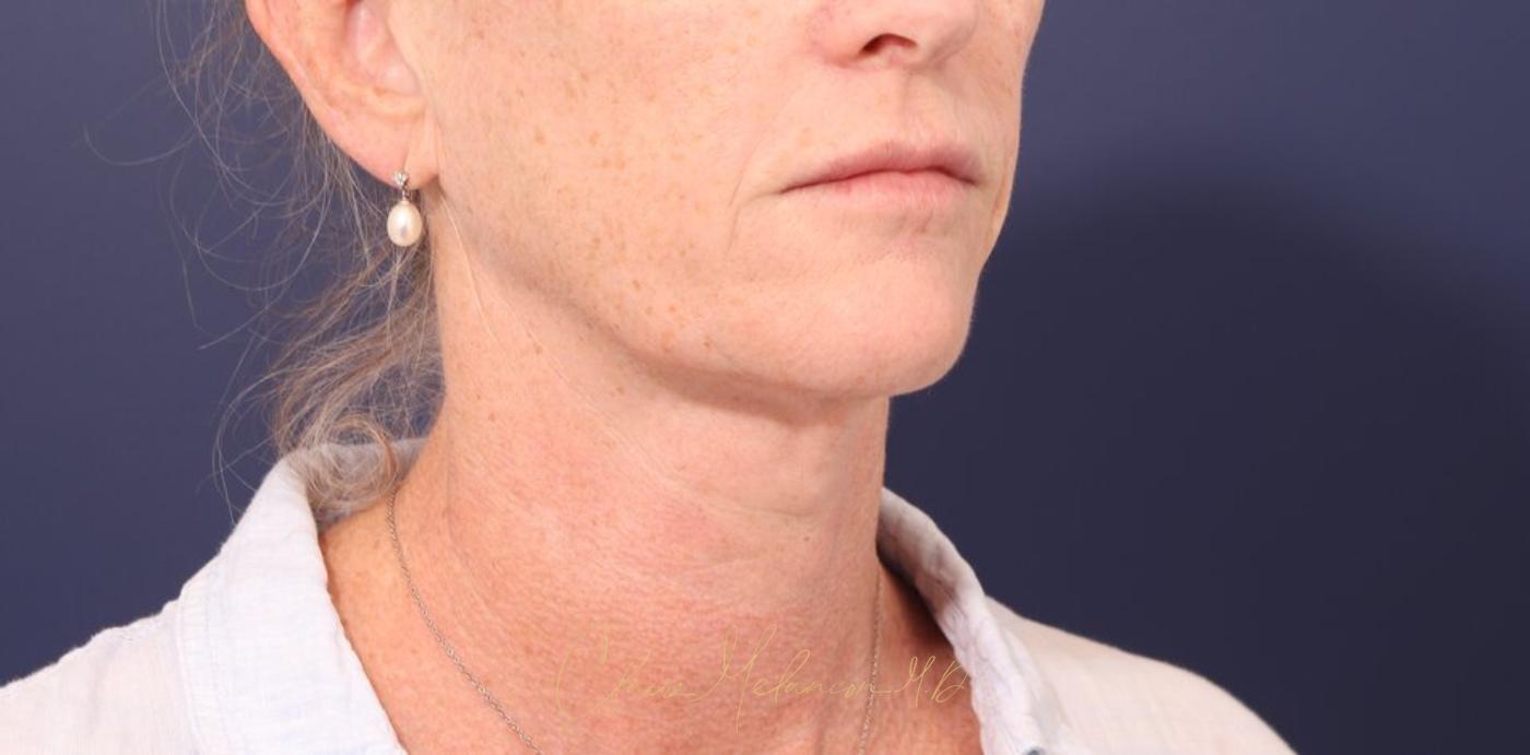 Facelift Before & After Photo