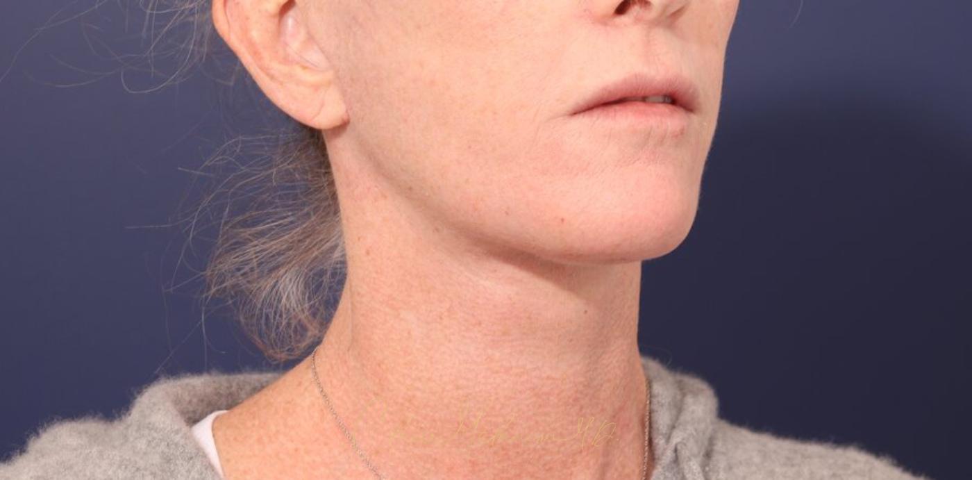 Facelift Before & After Photo