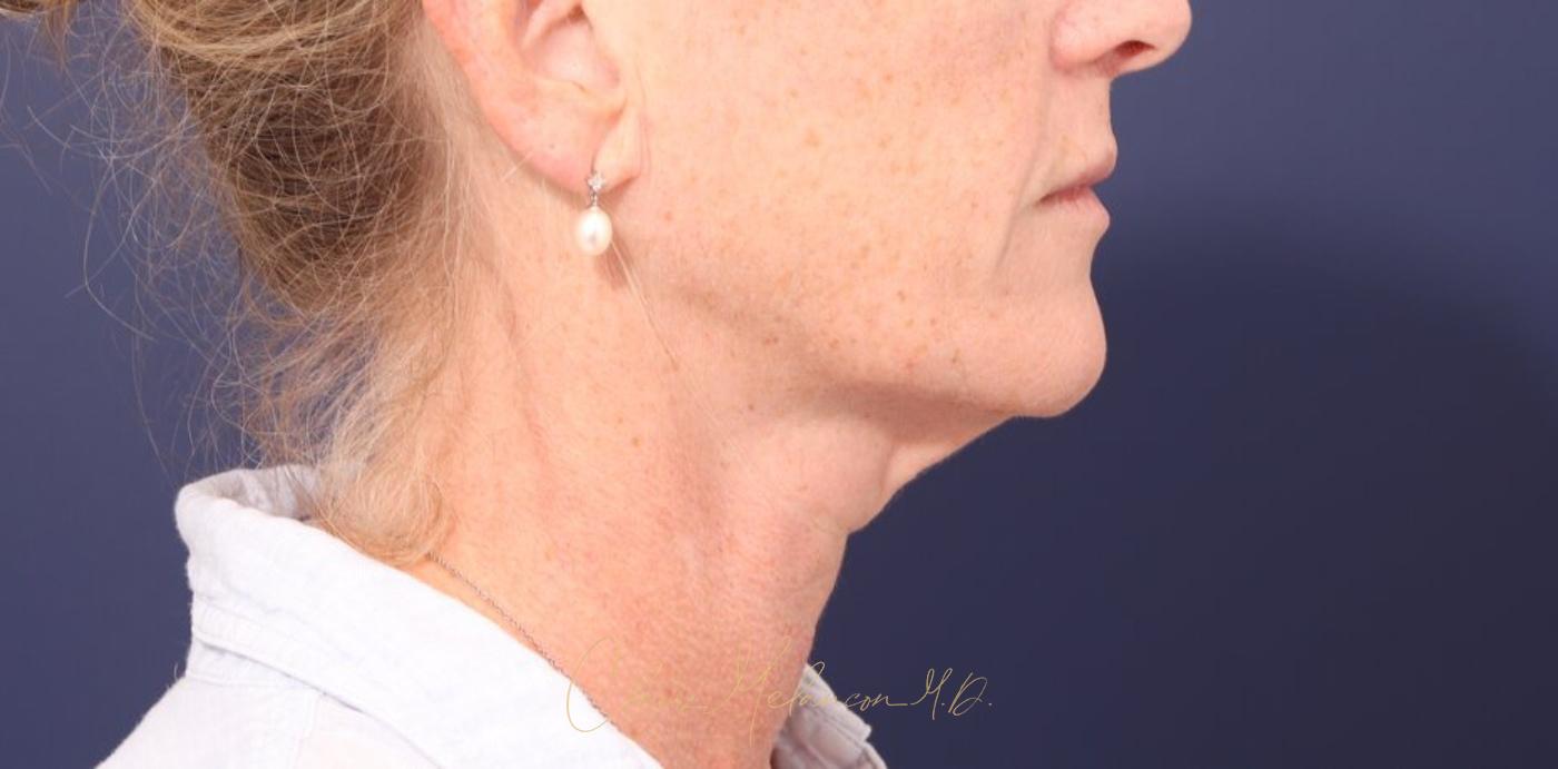 Facelift Before & After Photo