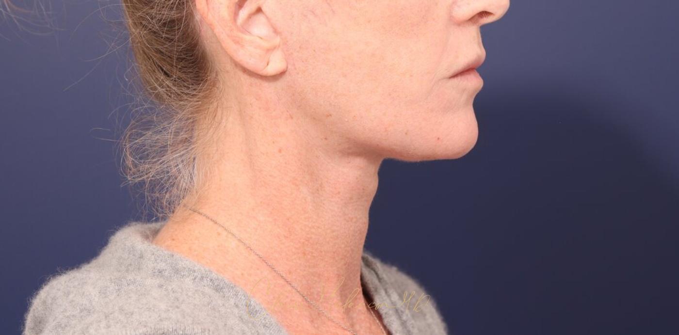 Facelift Before & After Photo