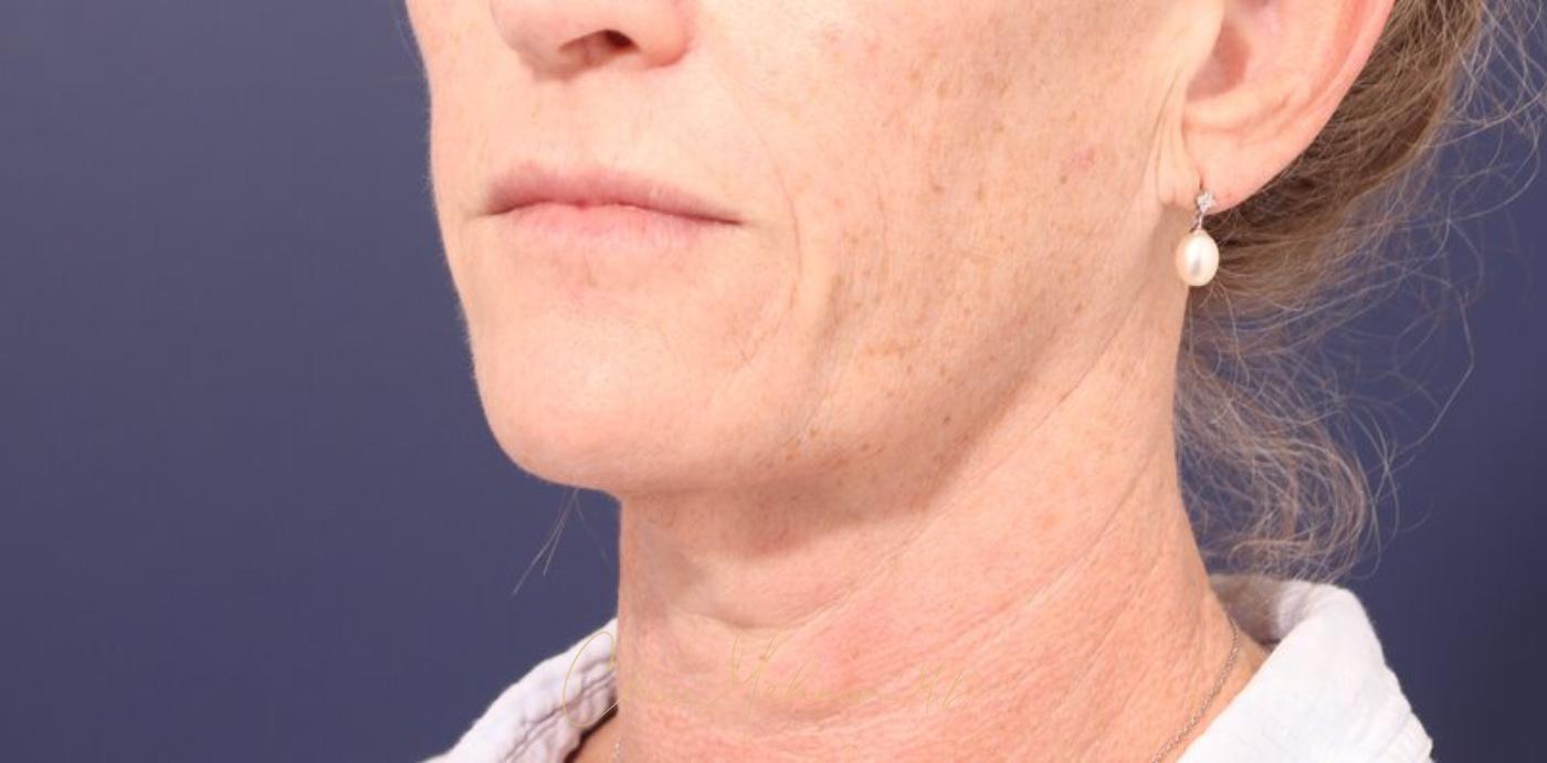 Facelift Before & After Photo