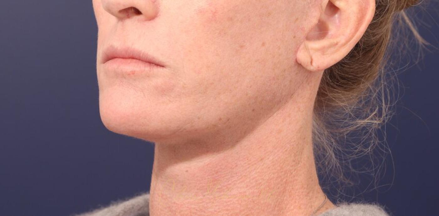 Facelift Before & After Photo