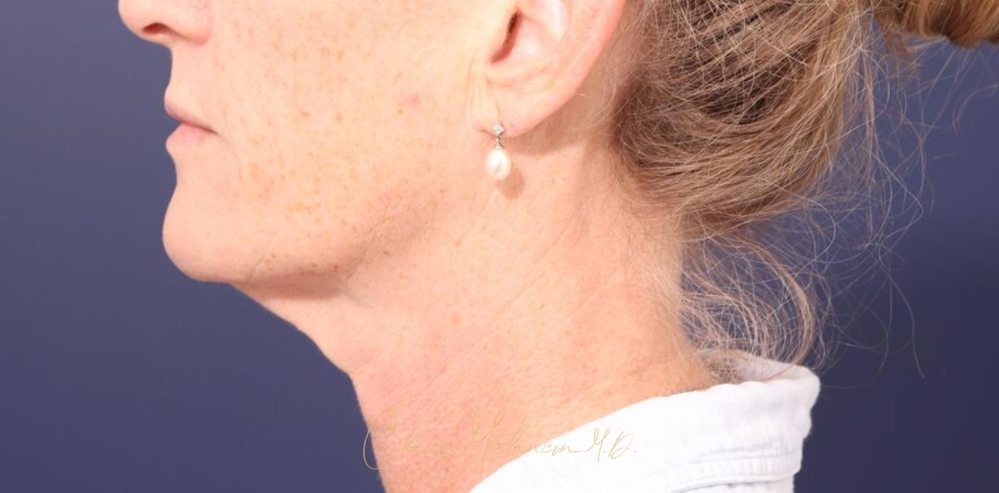 Facelift Before & After Photo