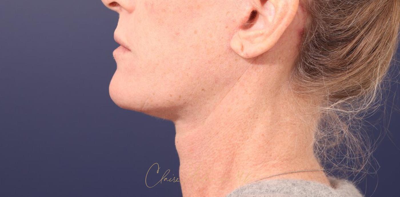 Facelift Before & After Photo