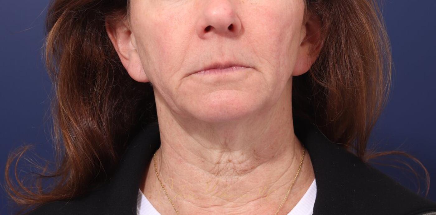 Facelift Before & After Photo
