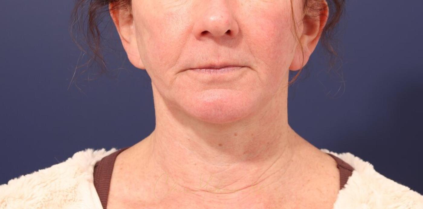 Facelift Before & After Photo