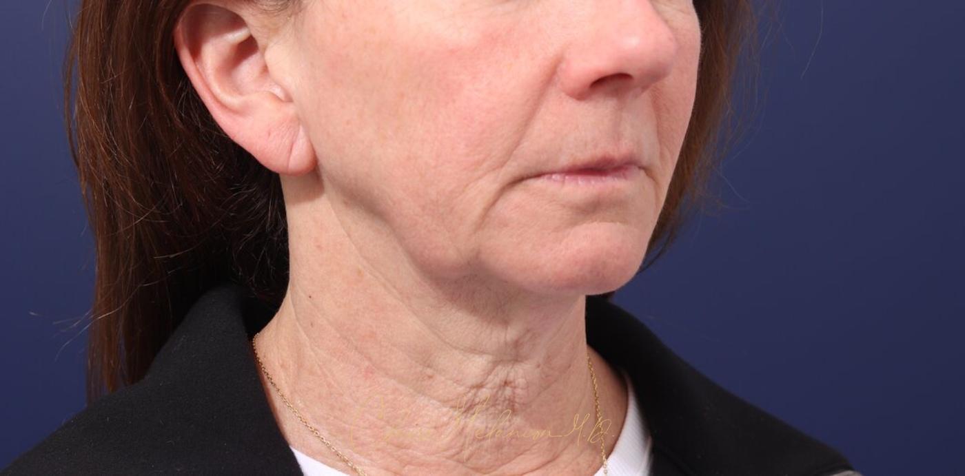 Facelift Before & After Photo