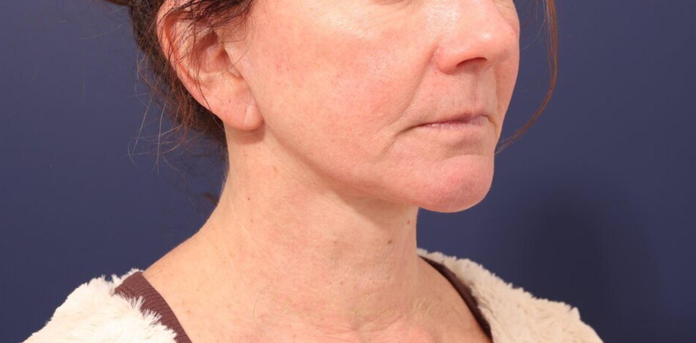 Facelift Before & After Photo