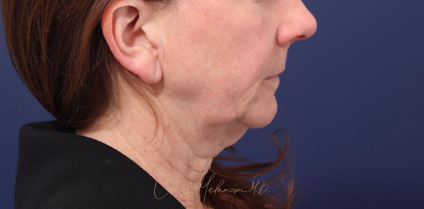 Facelift Before & After Photo