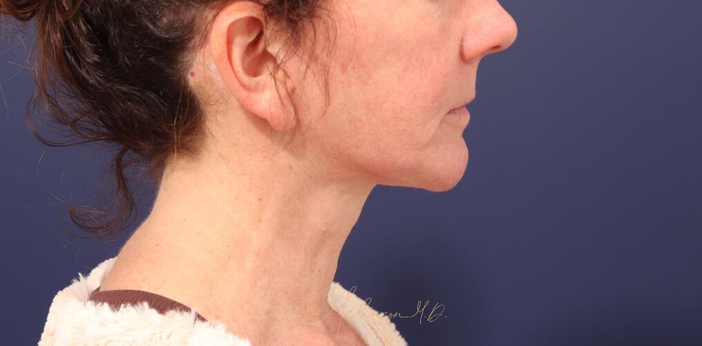 Facelift Before & After Photo