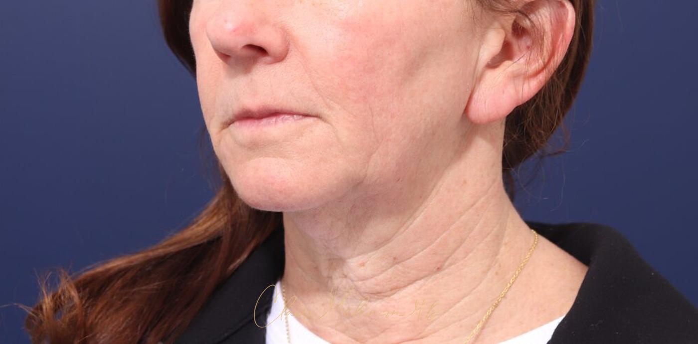 Facelift Before & After Photo