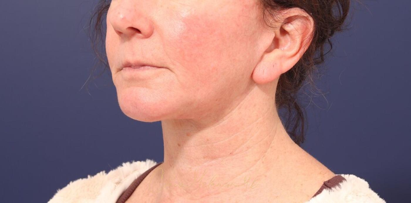 Facelift Before & After Photo