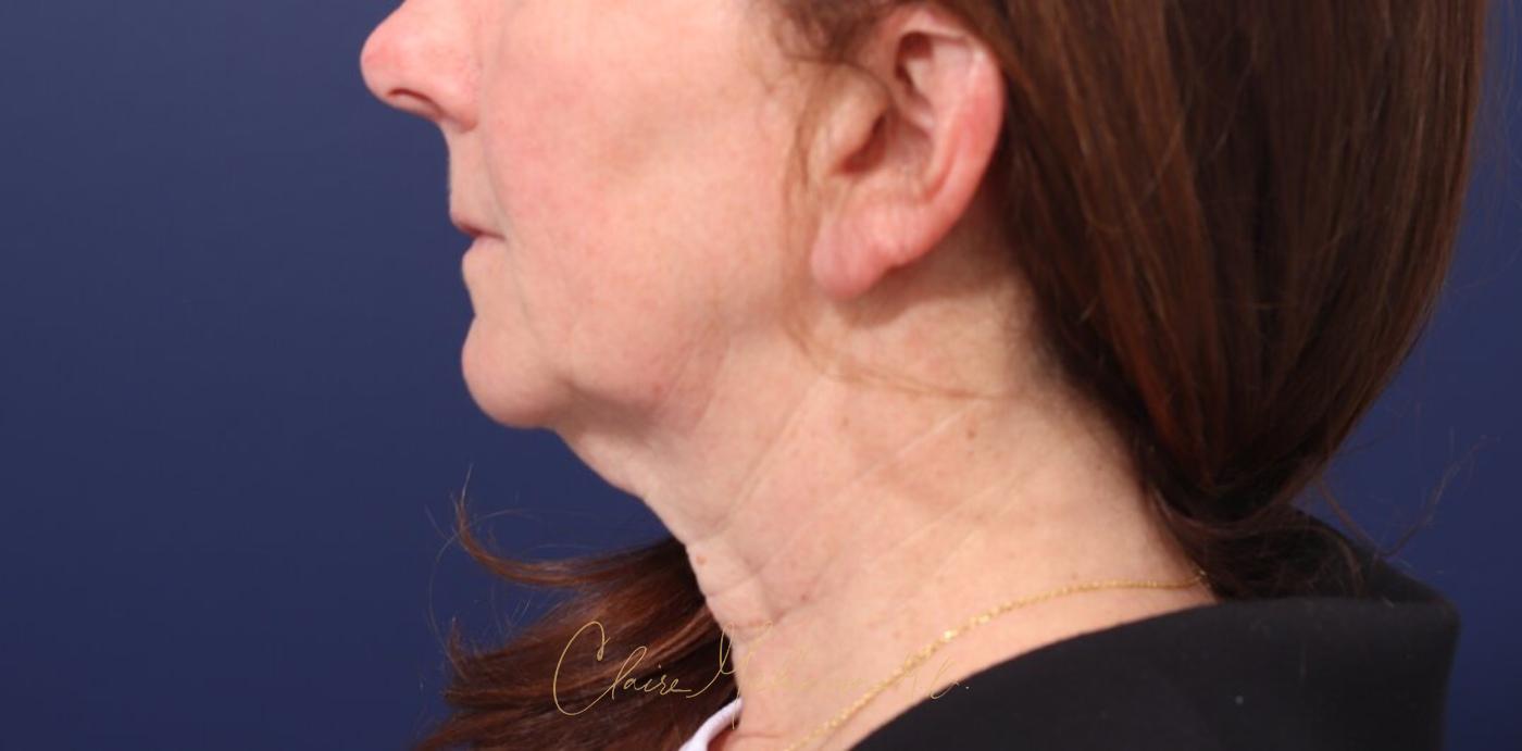 Facelift Before & After Photo