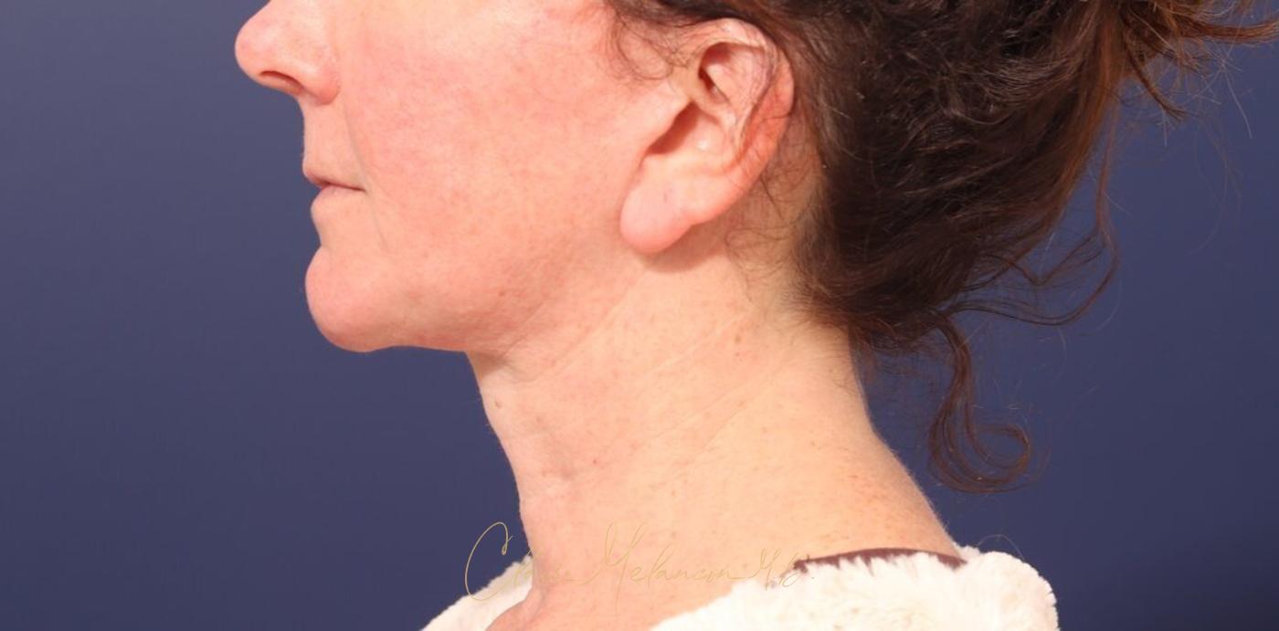 Facelift Before & After Photo