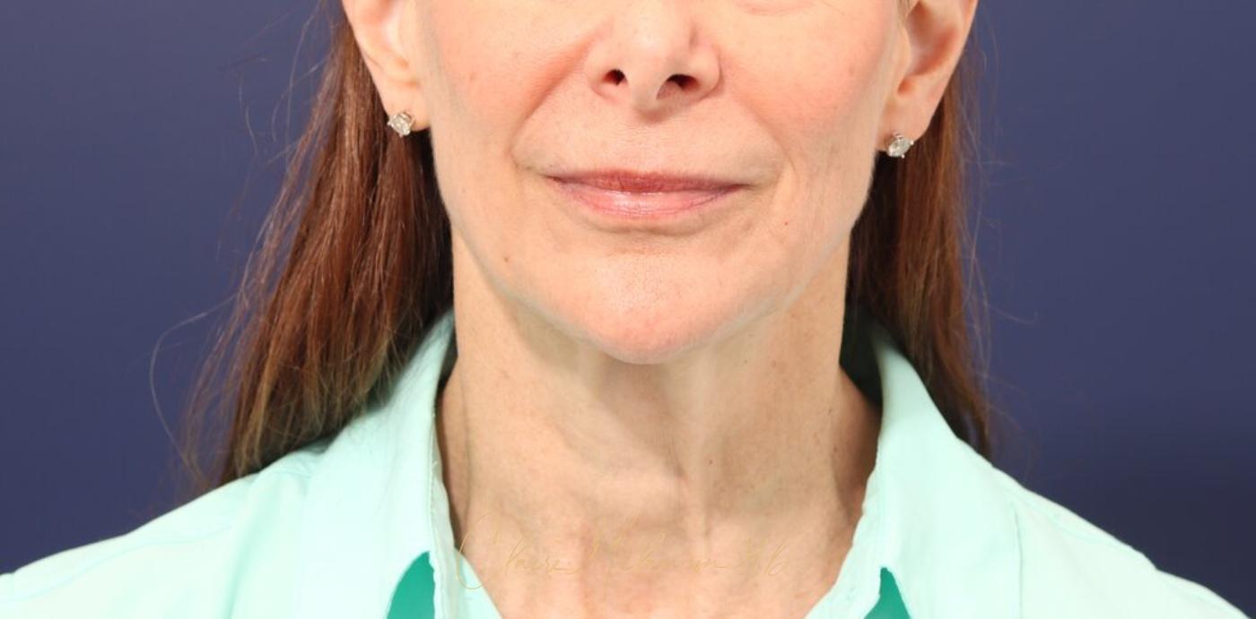 Facelift Before & After Photo