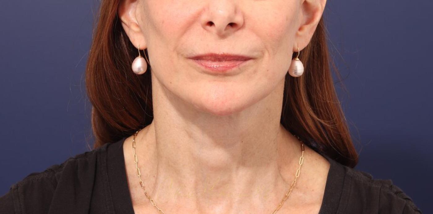 Facelift Before & After Photo
