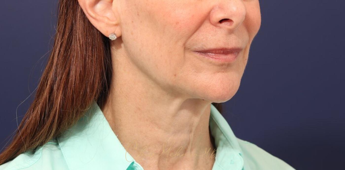 Facelift Before & After Photo