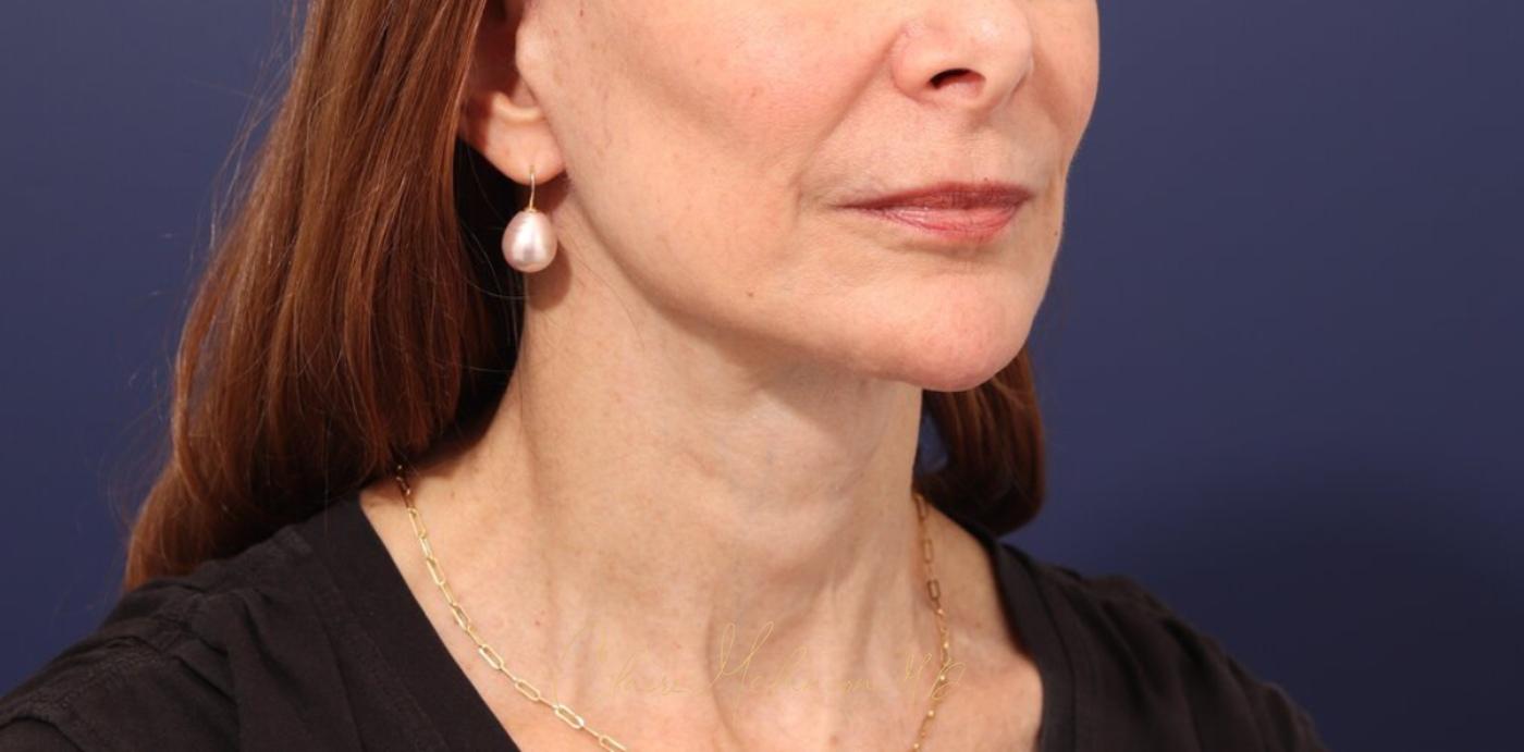 Facelift Before & After Photo