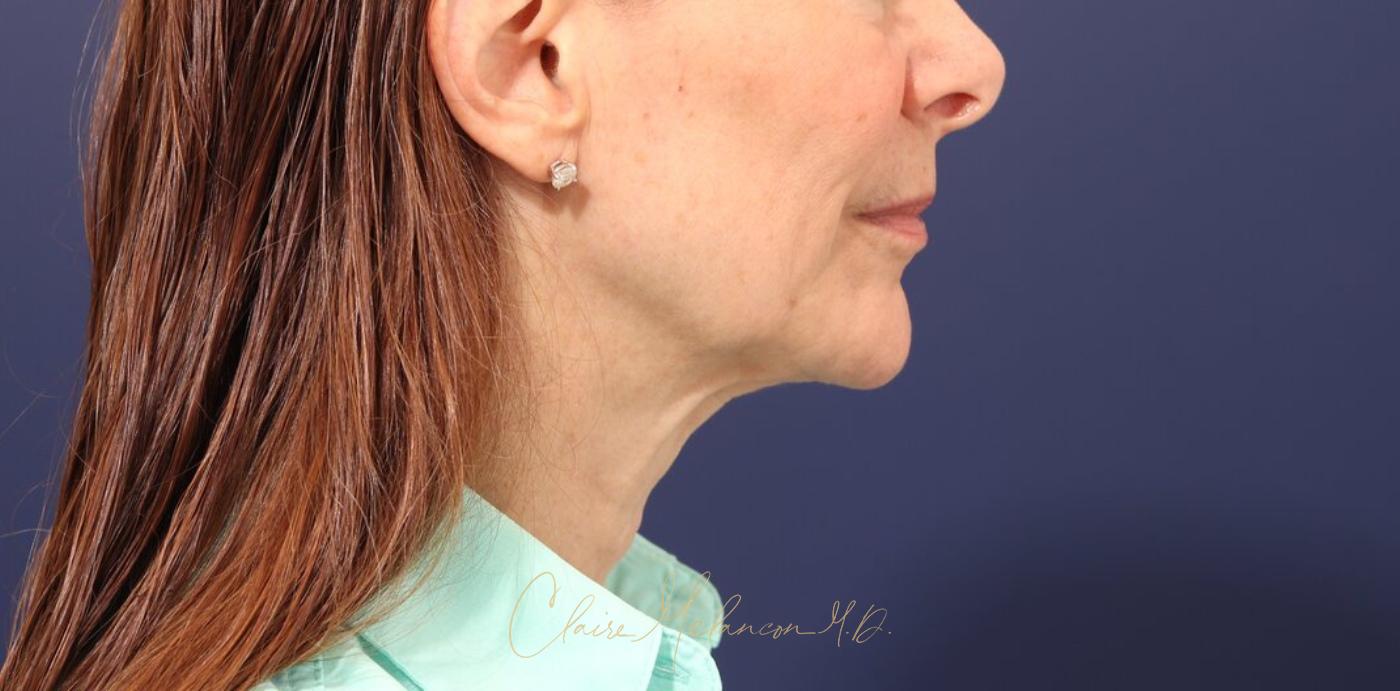 Facelift Before & After Photo