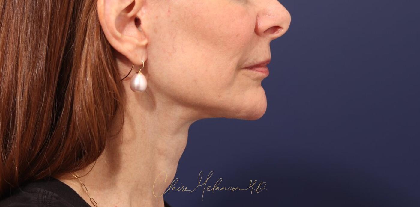 Facelift Before & After Photo