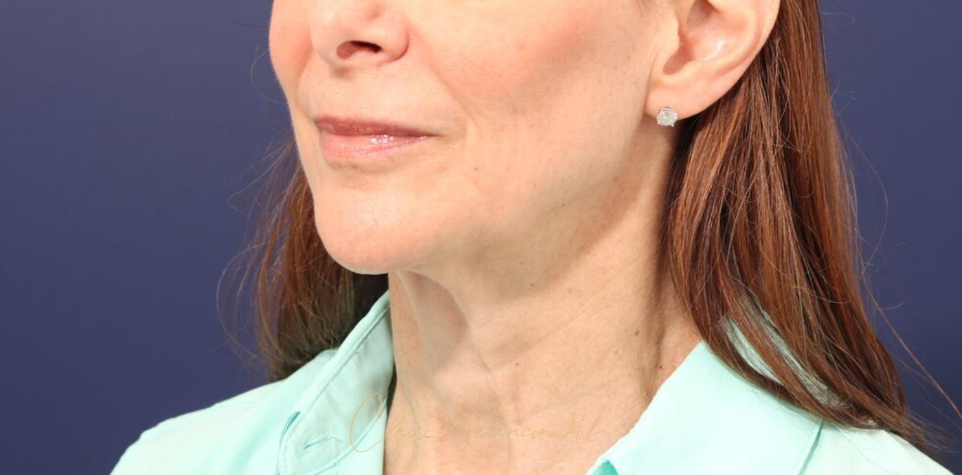 Facelift Before & After Photo