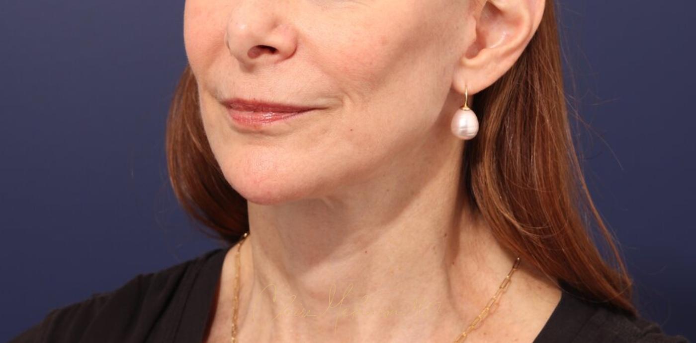 Facelift Before & After Photo
