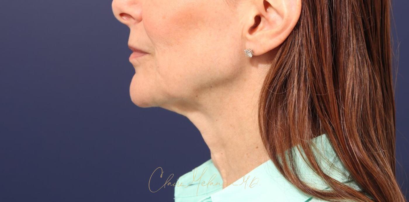 Facelift Before & After Photo