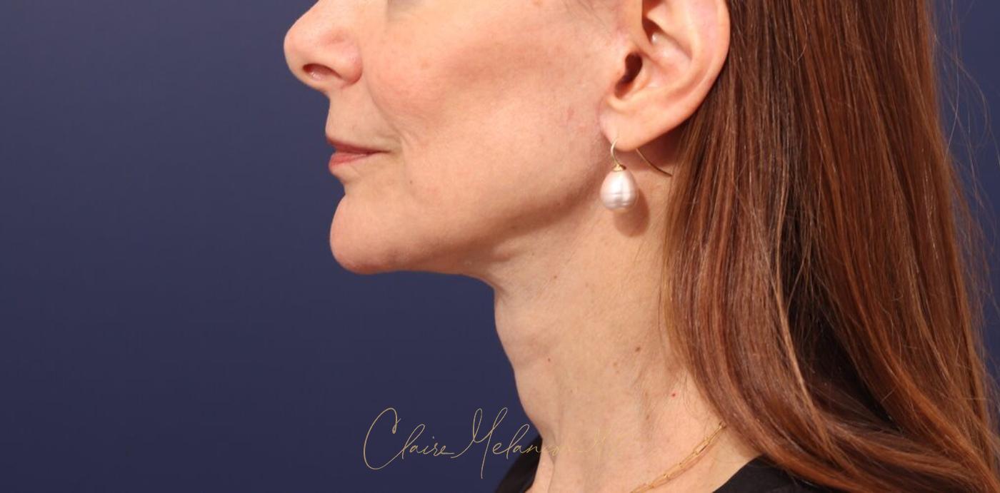 Facelift Before & After Photo