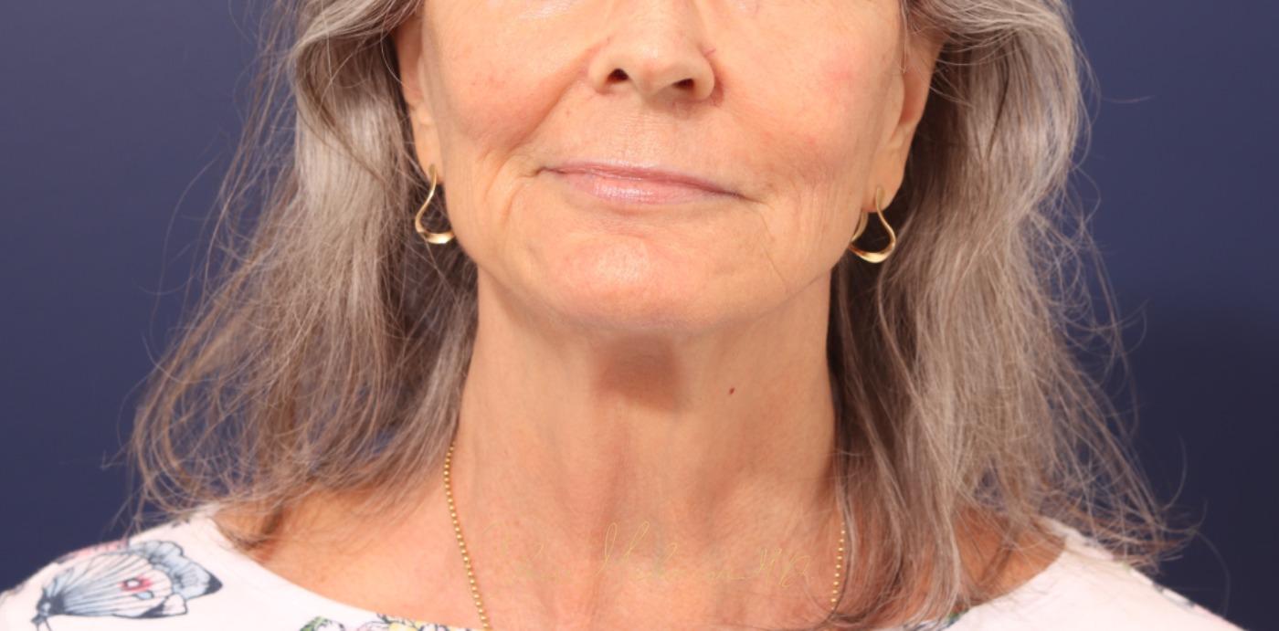 Lip Lift Before & After Photo
